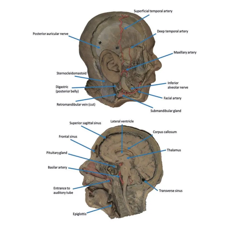 3D Printed Sagittal Section of Head with Infratemporal Fossa Dissection